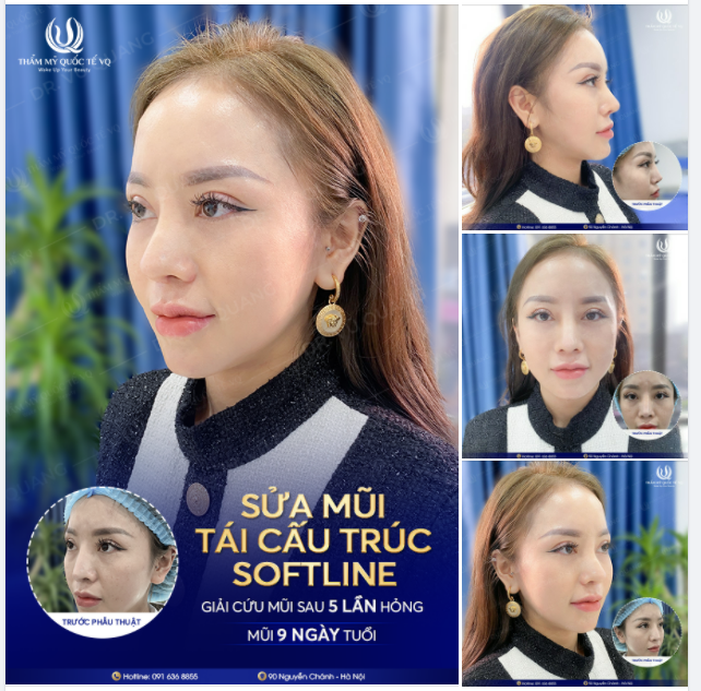 Bạn đã từng nâng mũi nhưng không được như ý