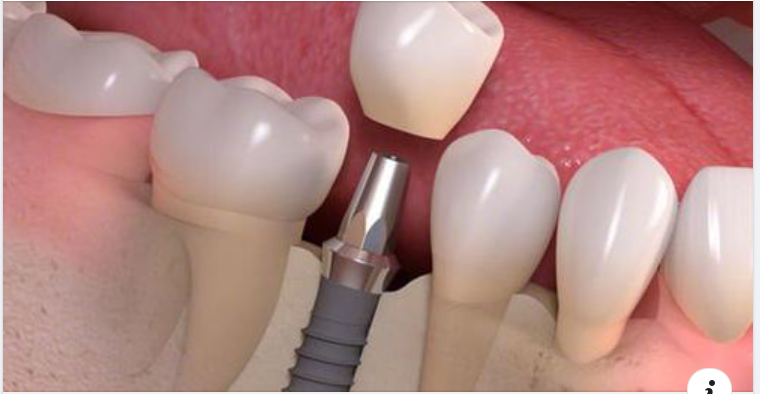 Bạn đang mất một hay nhiều răng?