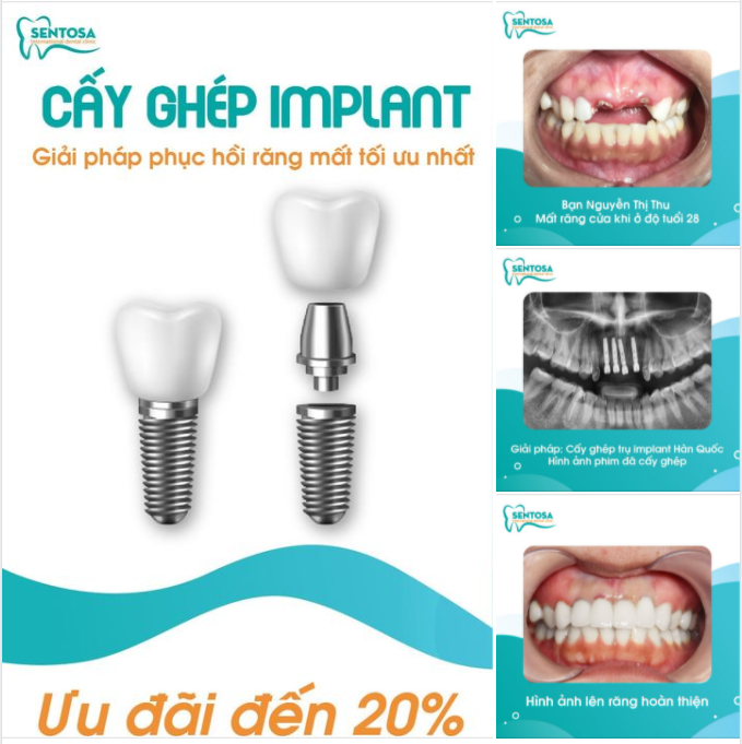 Bạn Nguyễn Thị Thu - 28 tuổi - Bị mất răng cửa và đã chọn phương pháp cấy ghép IMPLANT để cải thiện tình trạng của mình.