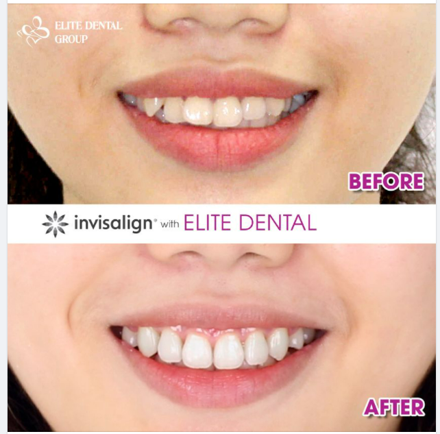 Bạn sẽ lãi những gì sau khi đầu tư vào niềng răng