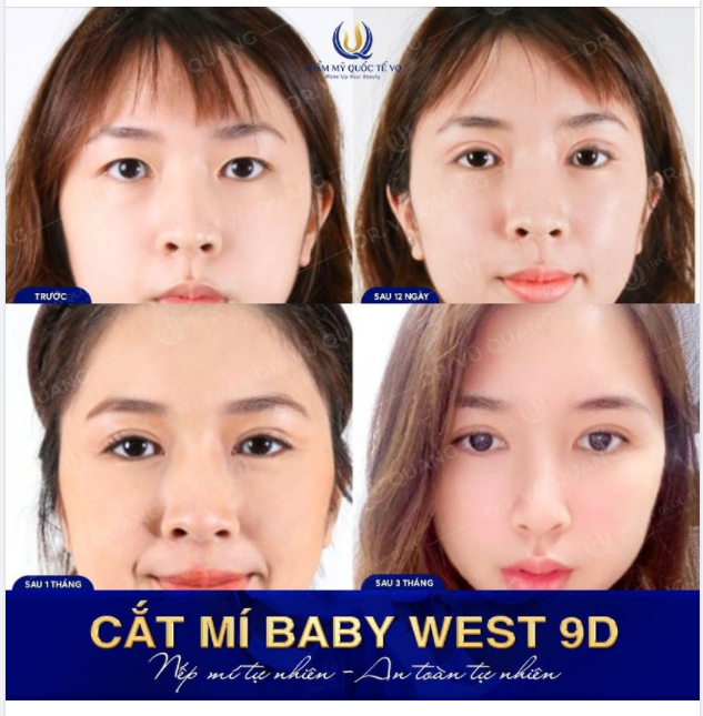 BẬT MÍ bí quyết sở hữu đôi mắt hai mí hút ánh nhìn