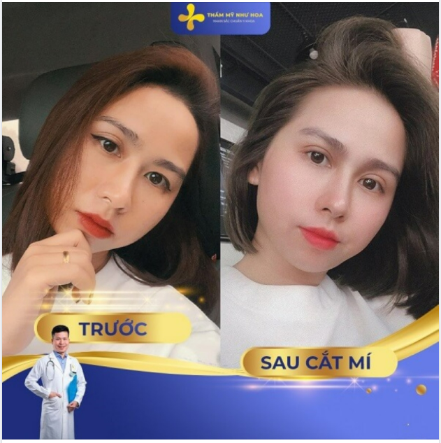 BẬT MÍ ĐỘ TUỔI PHÙ HỢP ĐỂ THỰC HIỆN CẮT MÍ MẮT