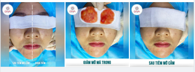 BÍ QUYẾT ĐỂ VÙNG MẶT DƯỚI SĂN CHẮC, THON GỌN