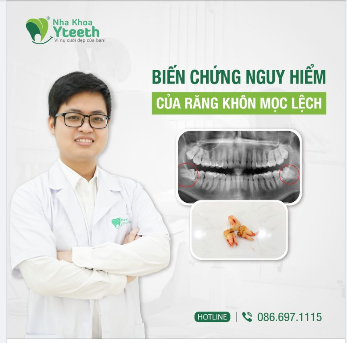 BIẾN CHỨNG NGUY HIỂM CỦA RĂNG KHÔN MỌC LỆCH