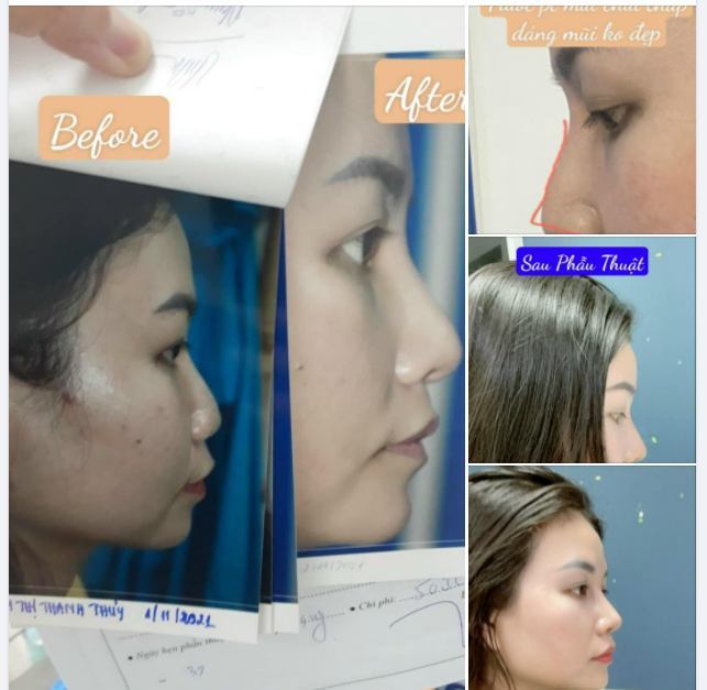 BIẾN HÌNH CHIẾC MŨI KHÁ NHIỀU KHUYẾT ĐIỂM CỦA KHÁCH HÀNG