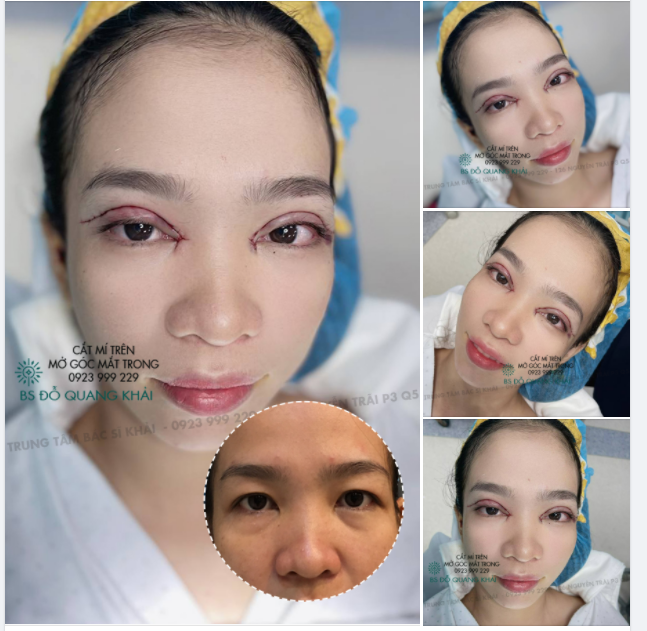 BIẾN HÌNH ĐÔI MẮT 1 MÍ THÀNH 2 MÍ TO TRÒN