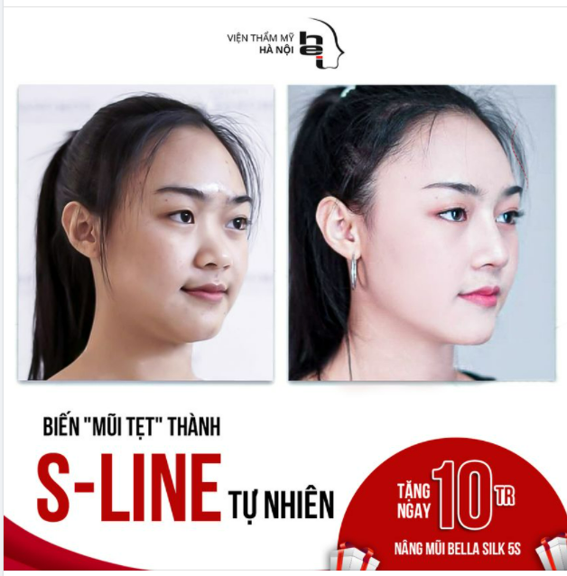 Biến mũi tẹt thành S-Line tự nhiên