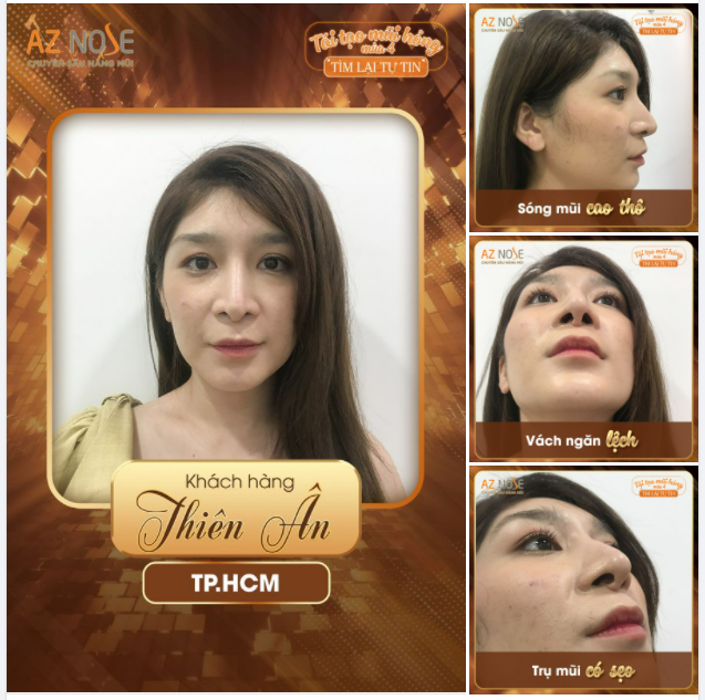 Bỏ lỡ cơ hội chỉ vì dáng mũi không đẹp như người khác...