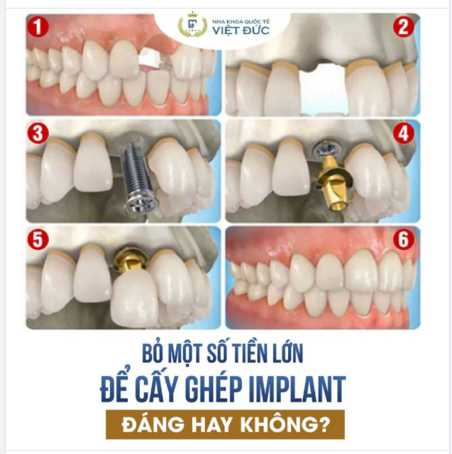 BỎ RA MỘT SỐ TIỀN LỚN LÀM RĂNG IMPLANT CÓ ĐÁNG HAY KHÔNG