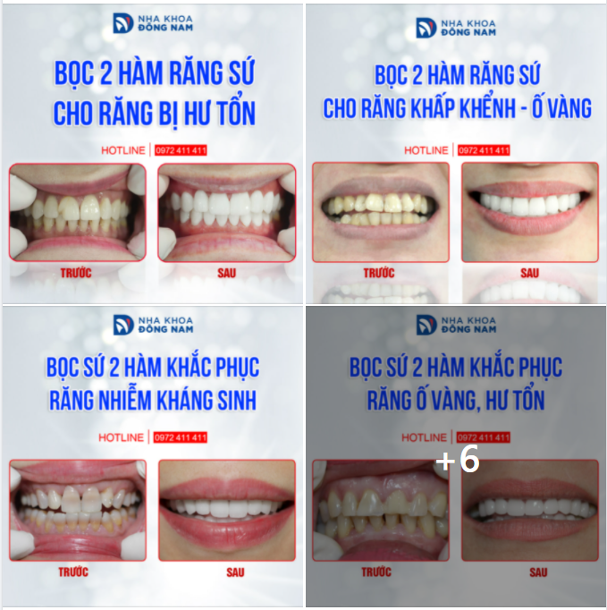 BỘ SƯU TẬP RĂNG TOÀN SỨ CAO CẤP HI-ZIRCONIA