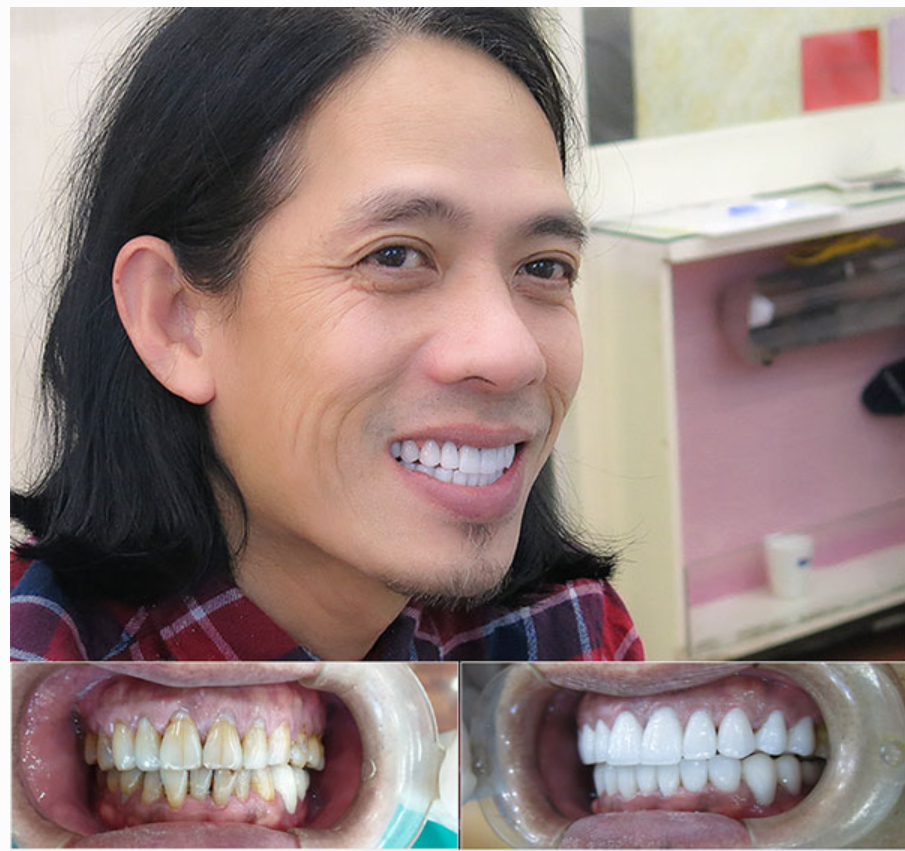 Bọc răng sứ có đau không?