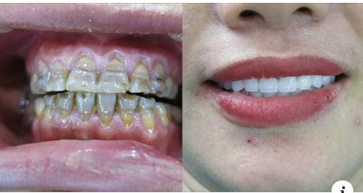 Bọc răng sứ hay dán sứ Veneer tốt?