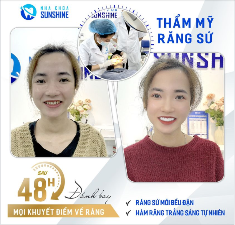 BỌC RẮNG SỨ THẨM MỸ - KẾT QUẢ ĐẸP NGAY SAU 48H