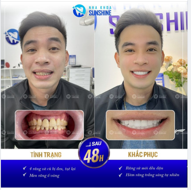 BỌC RẮNG SỨ THẨM MỸ - KẾT QUẢ ĐẸP NGAY SAU 48H