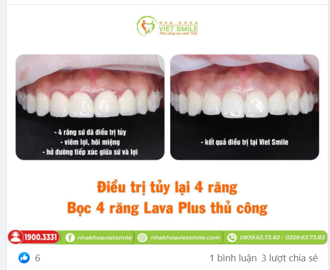 BỌC SỨ THẨM MỸ 4R LAVA PLUS THỦ CÔNG - GIẢI CỨU RĂNG SỨ SAI KỸ THUẬT