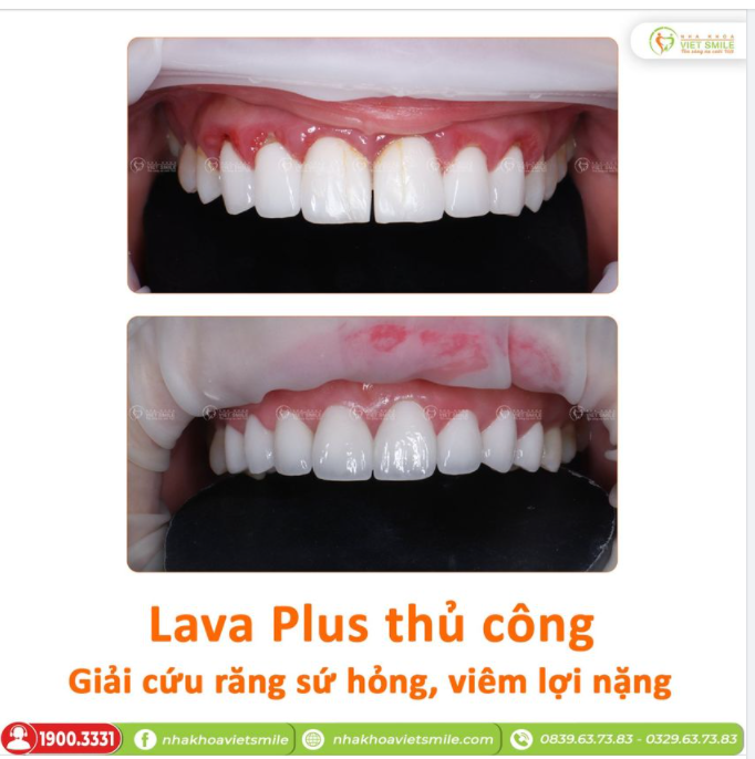 BỌC SỨ THẨM MỸ LAVA PLUS THỦ CÔNG - GIẢI CỨU THÀNH CÔNG SỨ HỎNG, VIÊM LỢI NẶNG