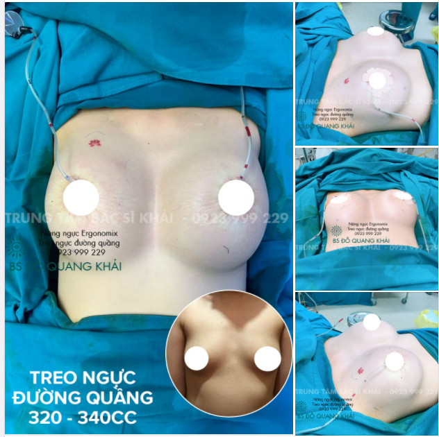 BỎNG MẮT VỚI TREO NGỰC KẾT HỢP ĐẶT TÚI