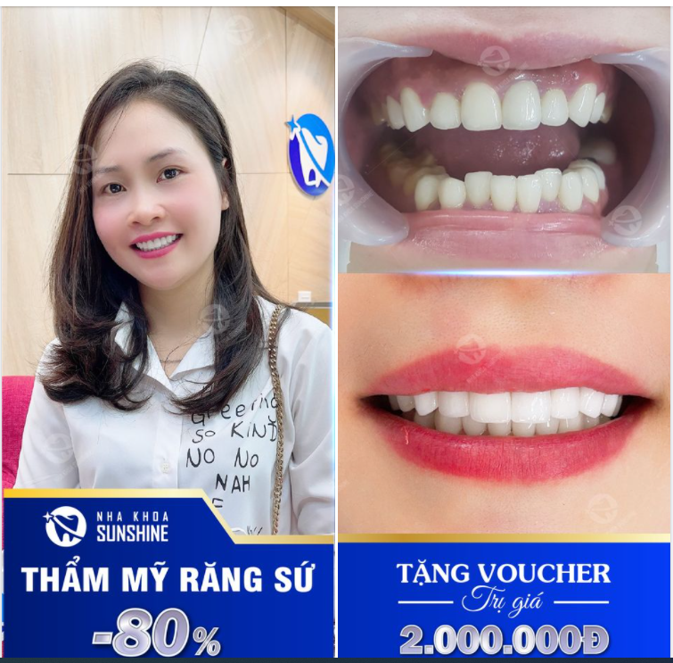 BÙNG NỔ ƯU ĐÃI LÀM RĂNG SỨ TẠI SUNSHINE