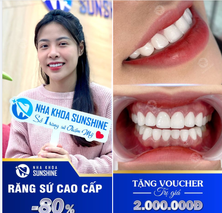 BÙNG NỔ ƯU ĐÃI LÀM RĂNG SỨ TẠI SUNSHINE