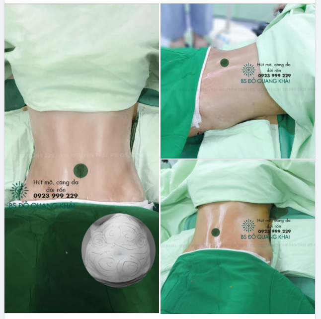 BỤNG PHẲNG NHƯ MƠ SAU HÚT MỠ CĂNG DA BSK