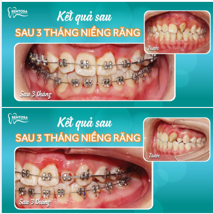 BƯỚC CHUYỂN BIẾN KINH NGẠC CỦA RĂNG KHẤP KHỂNH, DỊ DẠNG 