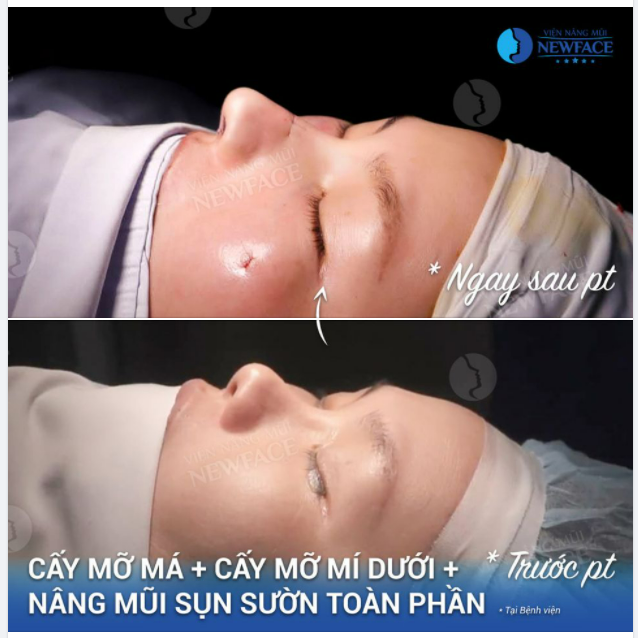 Ca 3 dịch vụ Cấy mỡ má + Mi Dưới + Nâng Sụn Sườn