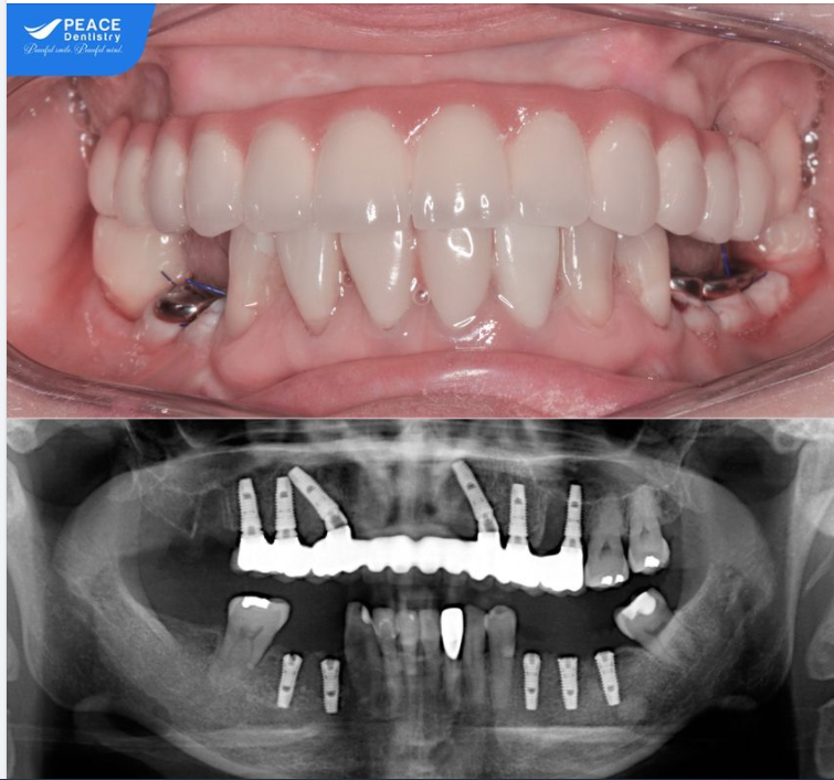 Ca lâm sàng All-on-6 Implant hàm trên để thay thế hàm tháo lắp và cấy 5 Implant thường quy ở hàm dưới cho khách hàng Việt Kiều