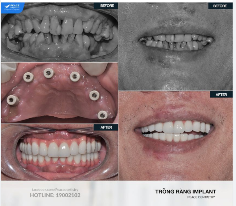 CA LÂM SÀNG ALL-ON-6 IMPLANT, PHỤC HÌNH TỨC THÌ HÀM BIOHPP