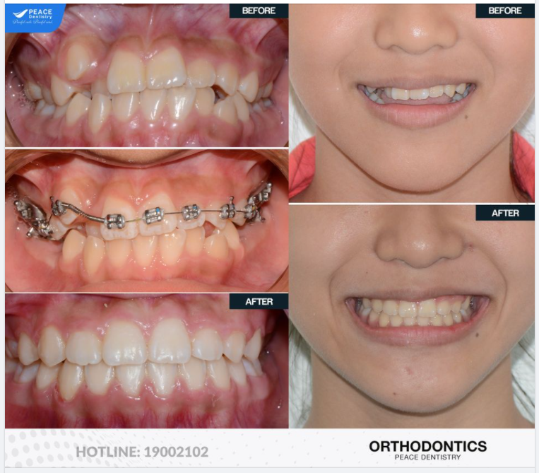 CA LÂM SÀNG CHỈNH NHA PHỨC TẠP CHO BÉ TUỔI TEEN