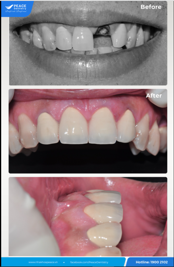 Ca lâm sàng nhổ chân răng,  cấy Implant tức thì và  phục hình tức thì  Hoàn thành sau 10 ngày