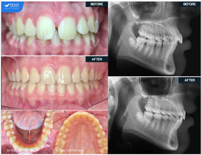 Ca lâm sàng: Niềng răng Invisalign cho bé tuổi teen