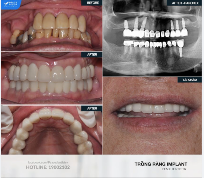 Ca lâm sàng  trồng răng Implant có ghép xương và những ghi nhận khi tái khám sau nhiều năm ăn nhai.