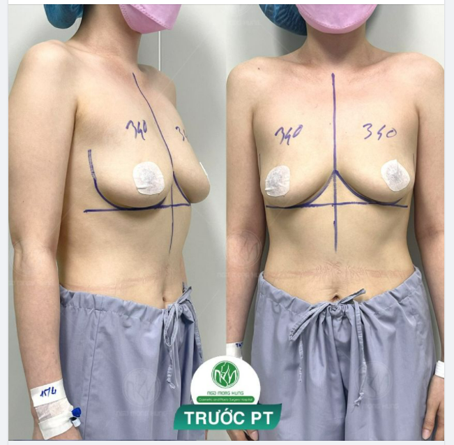 CA NÂNG NGỰC CHO KHÁCH HÀNG CAO 1M58