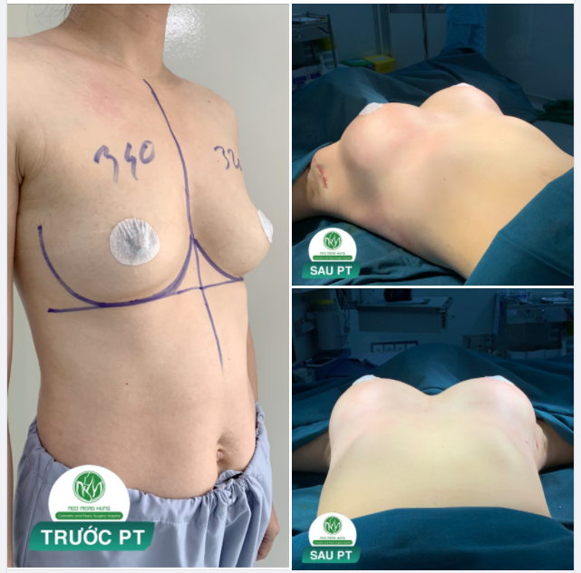 CA NÂNG NGỰC MỚI NHẤT TẠI BỆNH VIỆN