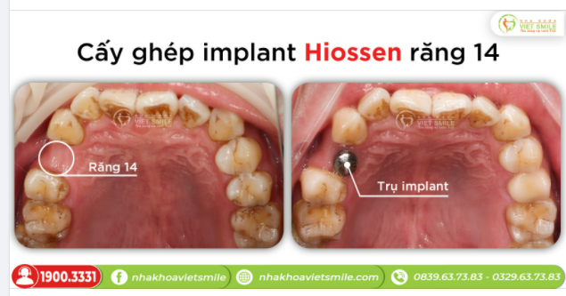 CẤY GHÉP IMPLANT HIOSSEN RĂNG 14