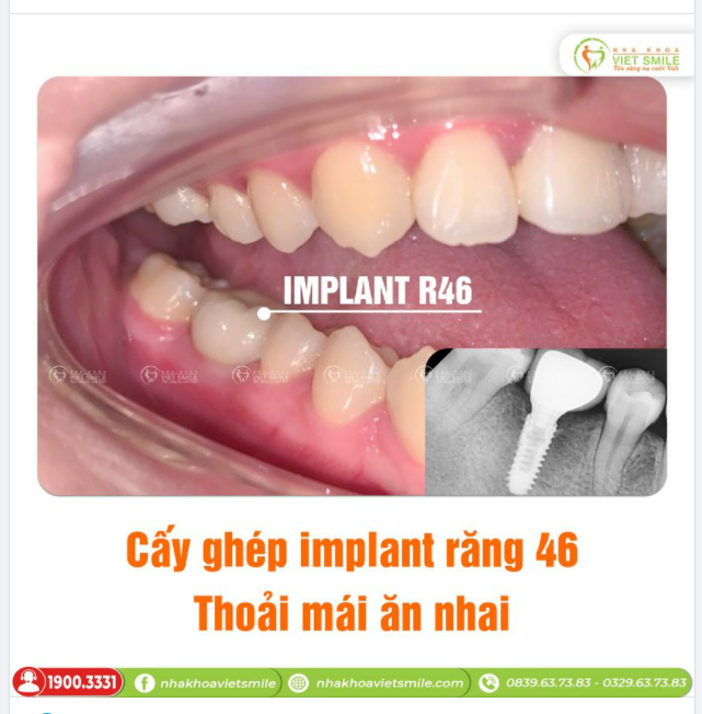 CẤY IMPLANT RĂNG 46 - THOẢI MÁI ĂN NHAI