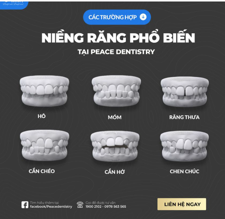 CÁC TRƯỜNG HỢP NIỀNG RĂNG PHỔ BIẾN TẠI PEACE DENTISTRY