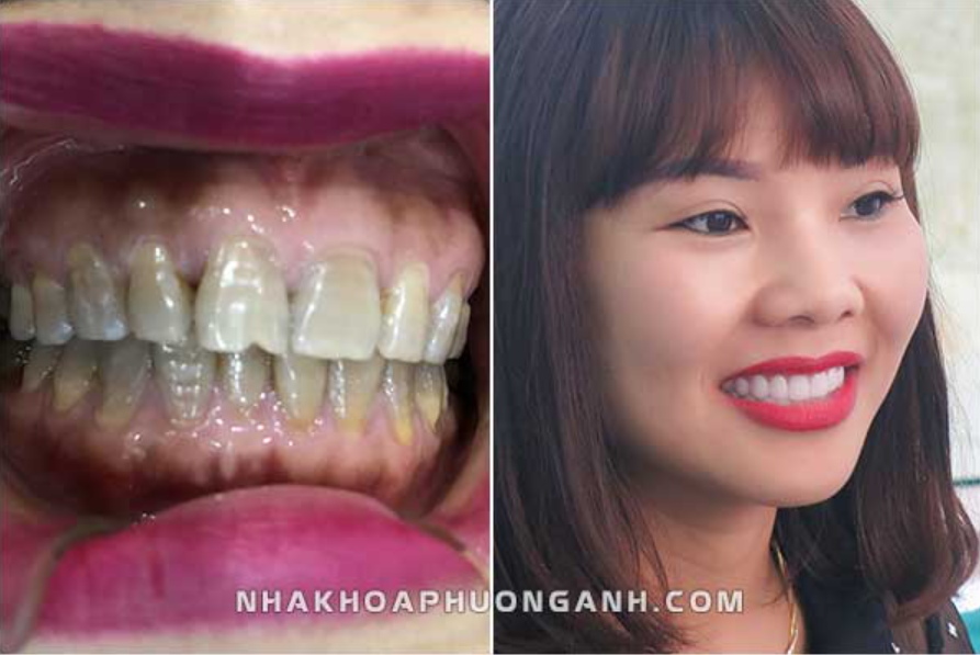 Cách Chọn Màu Răng Sứ Tự Nhiên Nhất?