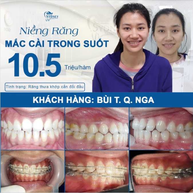 CÁCH XÁC ĐỊNH CHÍNH XÁC TÌNH TRẠNG RĂNG ĐỔI ĐẦU