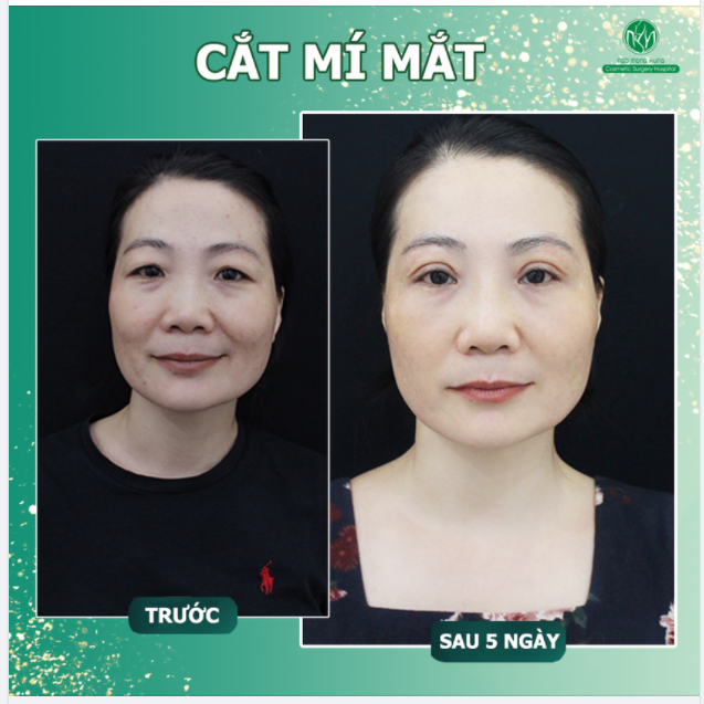 CẢI THIỆN ÁNH NHÌN - TRẺ TRUNG HƠN CHỈ SAU 5 NGÀY