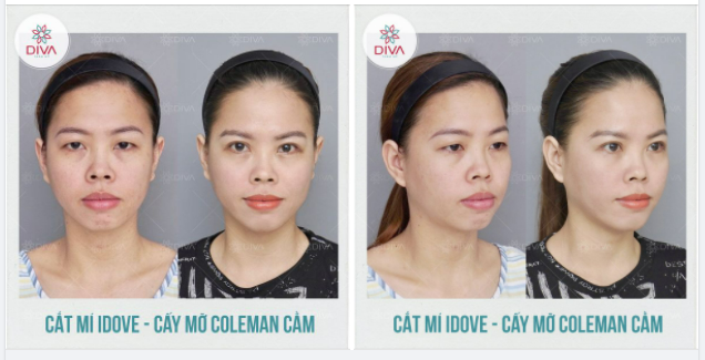 CẢI THIỆN CẰM LẸM, MÍ LÓT, MẮT NHỎ - GƯƠNG MẶT TƯƠI TRẺ, THU HÚT SAU THẨM MỸ