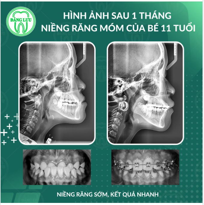 CẢI THIỆN MÓM CHỈ SAU 1 THÁNG NIỀNG RĂNG
