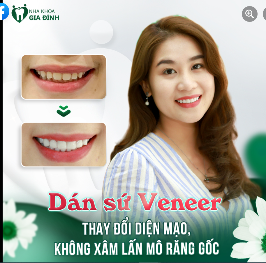 CẢI THIỆN RĂNG XỈN MÀU, HÌNH THỂ XẤU BẰNG DÁN SỨ VENEER