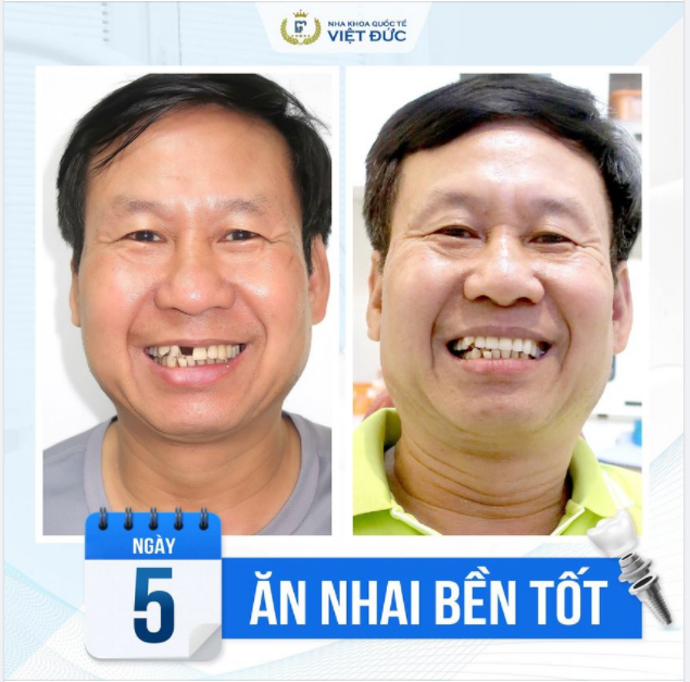 CẢM GIÁC ĂN NHAI CHÂN THẬT NÀY CHỈ CÓ ĐƯỢC NHỜ RĂNG IMPLANT