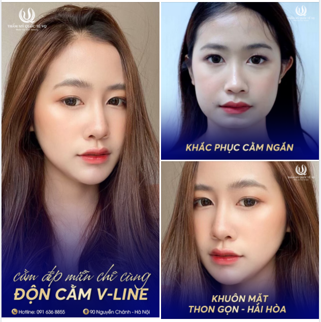 Cằm lẹm, cằm ngắn kém xinh Cằm vuông, cằm lệch mất cân đối