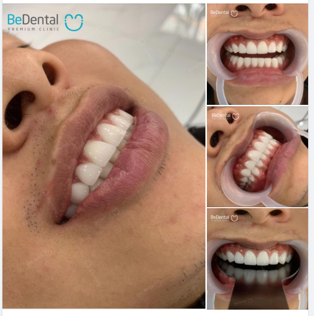 Cận cảnh hàm răng của anh khách hàng sau 2 năm làm thẩm mỹ tại Bedental