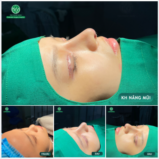 CẬN CẢNH KẾT QUẢ SAU NÂNG MŨI KẾT HỢP CẮT MÍ MẮT