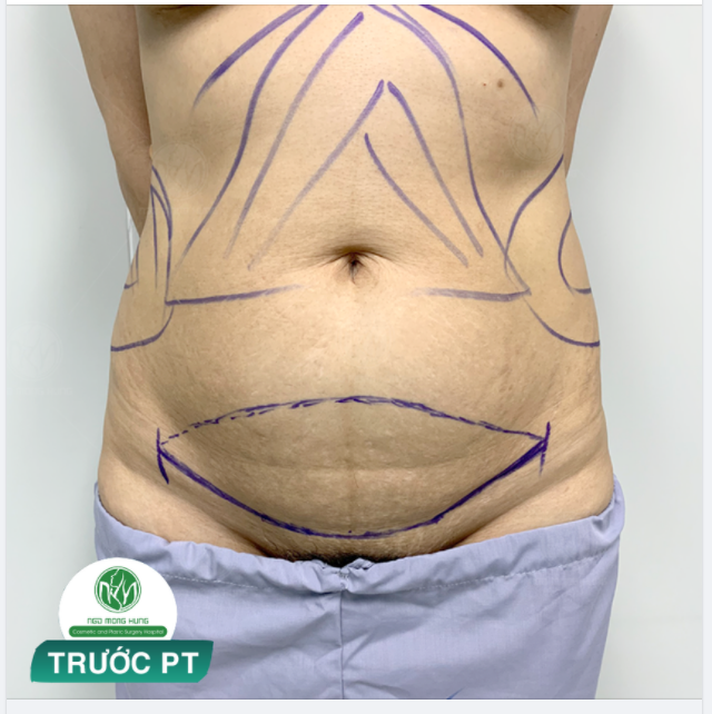 cân nhắc khá lâu chị mới có can đảm đi hút mỡ, tin tưởng nên chọn bệnh viện mong sẽ có vòng 2 thon gọn hơn...