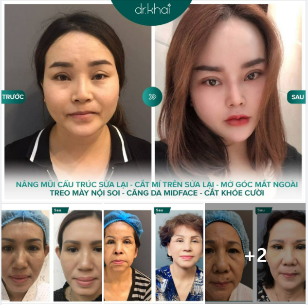 CĂNG DA MẶT - NÍU GIỮ NÉT XUÂN