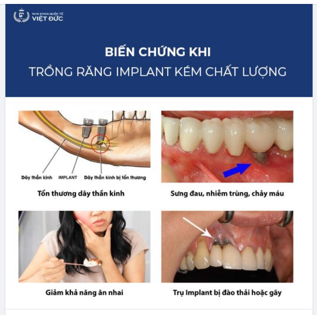 CẢNH BÁO BIẾN CHỨNG TRỒNG RĂNG IMPLANT KÉM CHẤT LƯỢNG